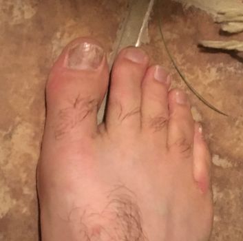 athletes foot on hand