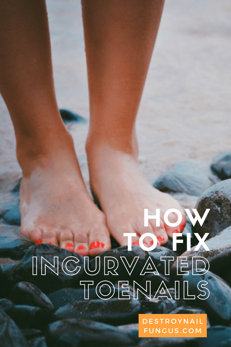 incurvated toenails