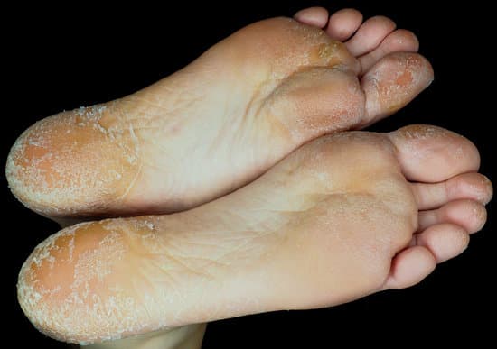 can nail fungus heal on its own