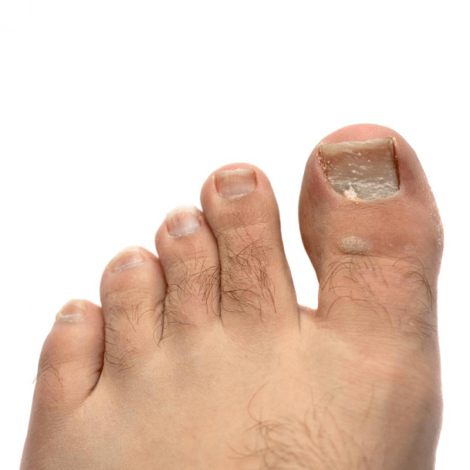 clove oil for toenail fungus