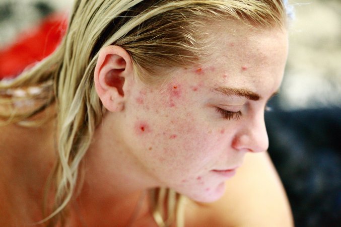 almond oil to tighten skin