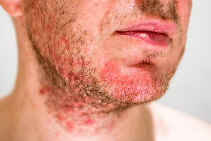 rash remedies itchy