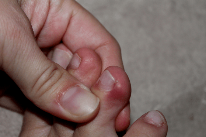 clove oil for toenail fungus