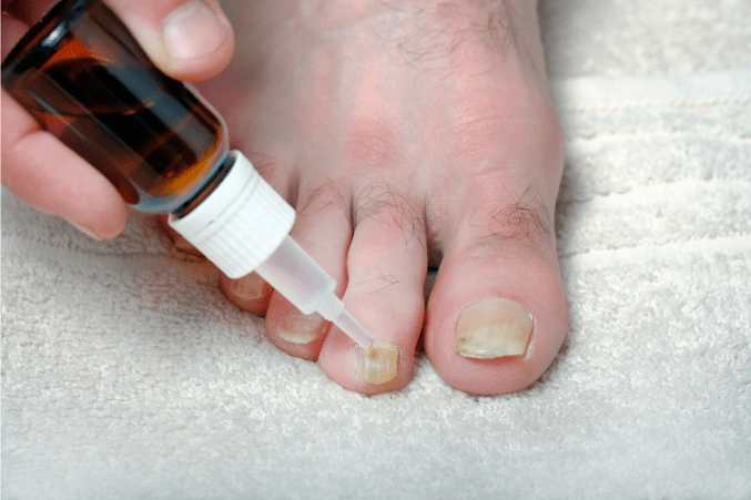 clove oil for toenail fungus