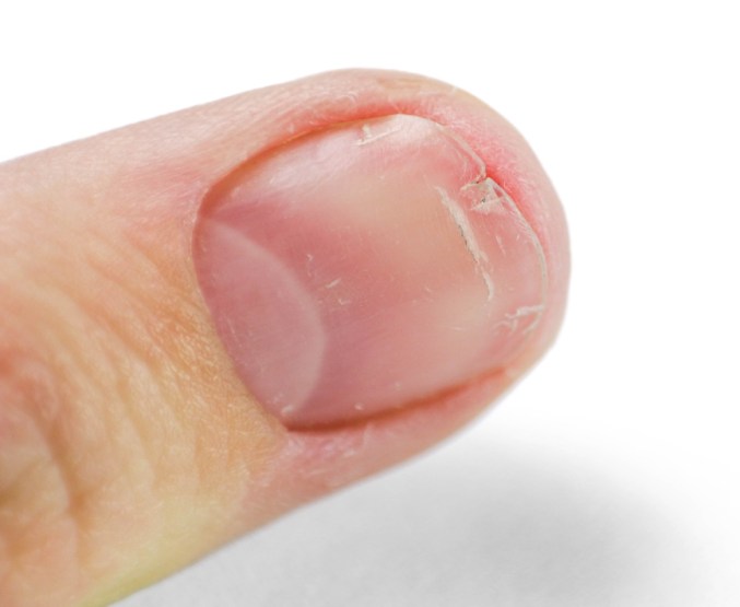 clove oil for toenail fungus