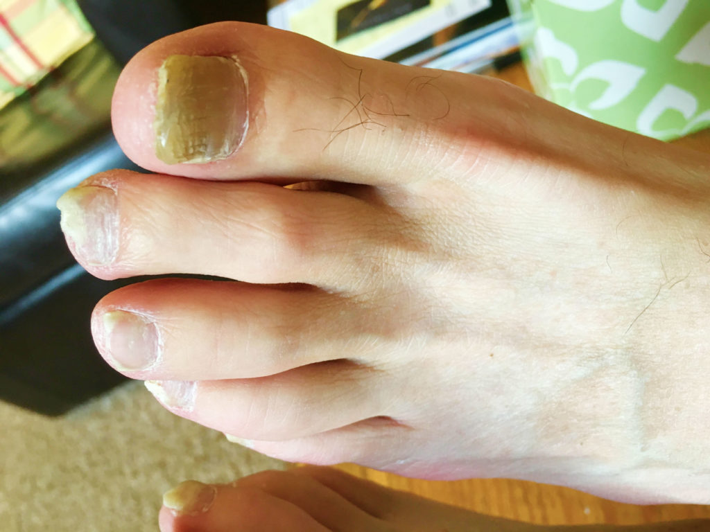 white spots on toenails after pedicure