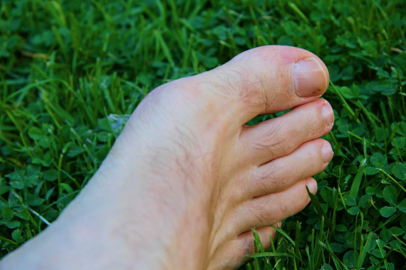 Signs Of Toenail Fungus Healing: What You Need To Know - Destroy Nail