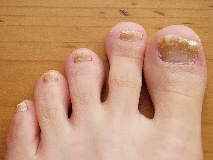 white vinegar to cure toenail fungus