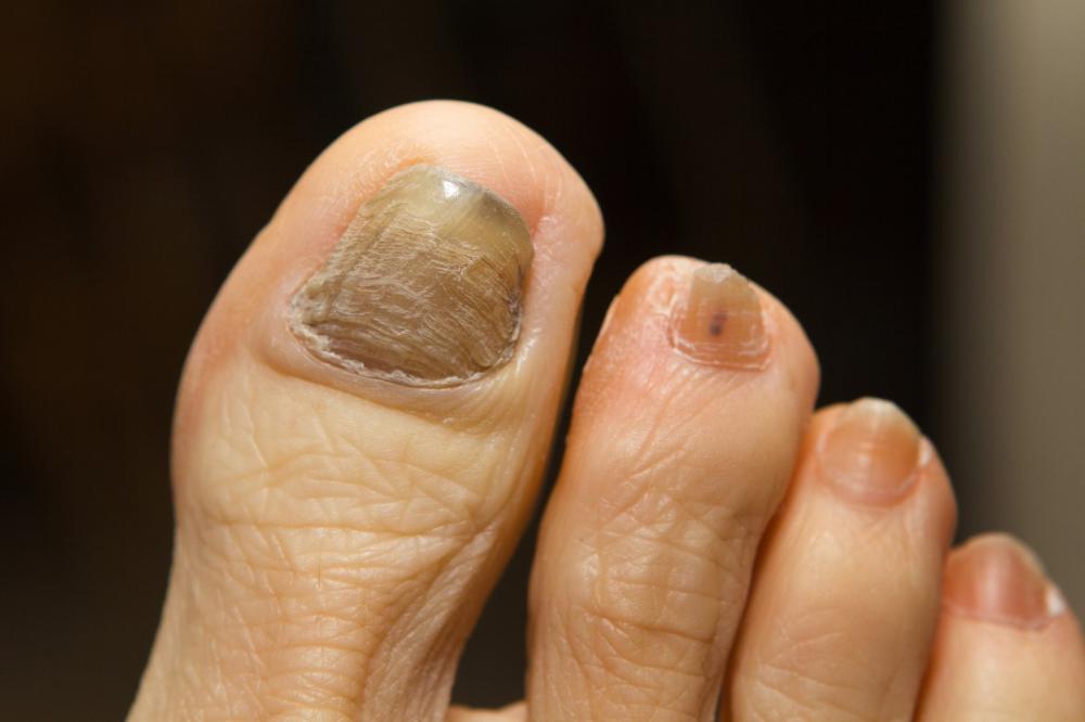 can nail fungus heal on its own