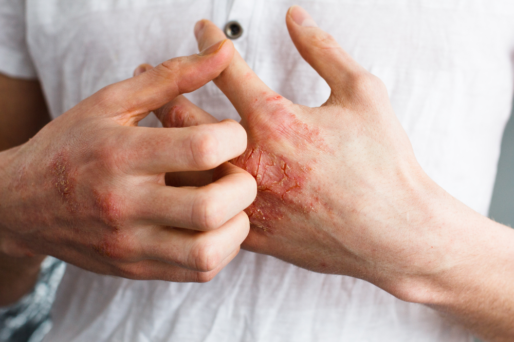 how to treat eczema with aloe vera