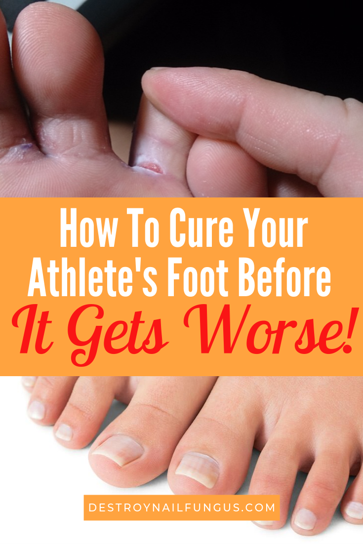 how to cure athletes foot before it gets worse