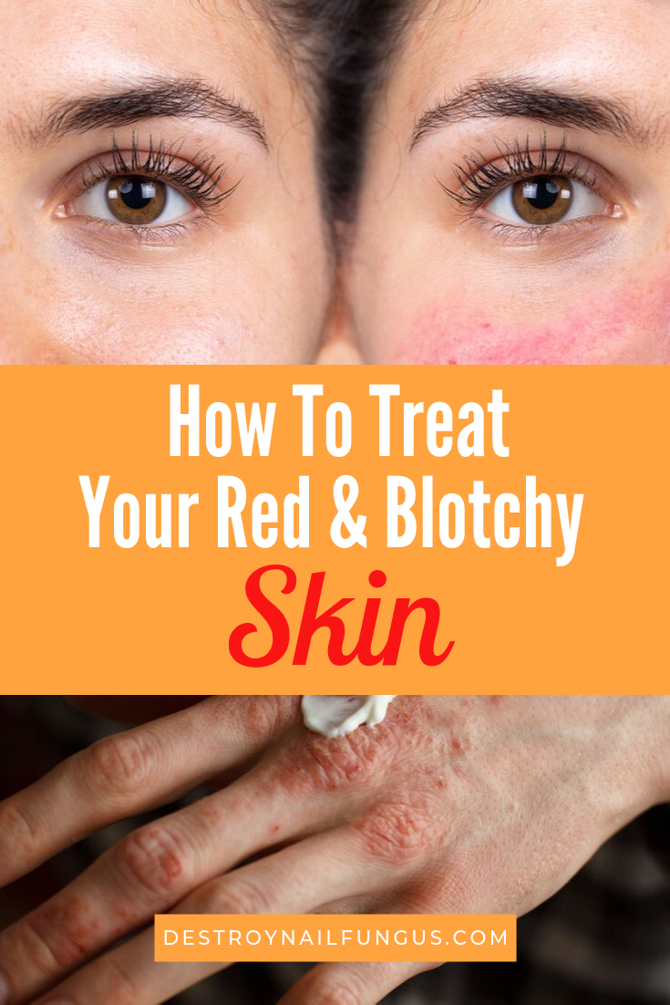 blotchy red skin home remedies
