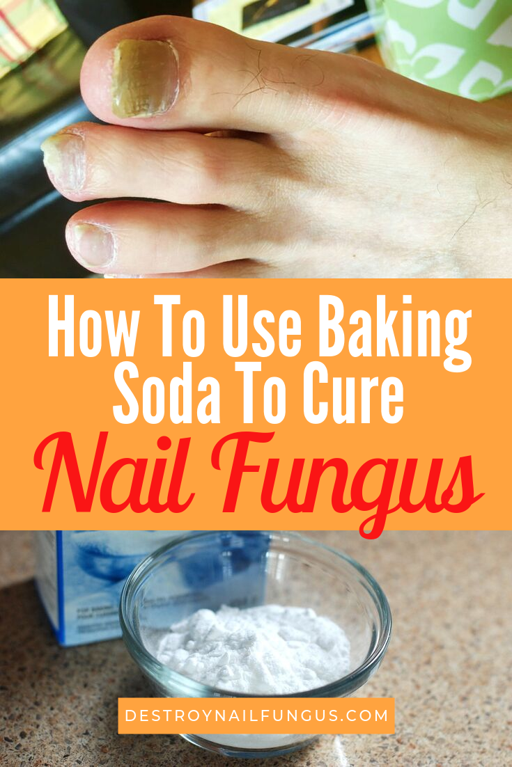 baking soda and nail fungus