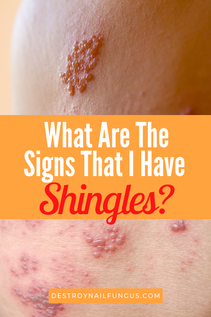 signs that you have shingles