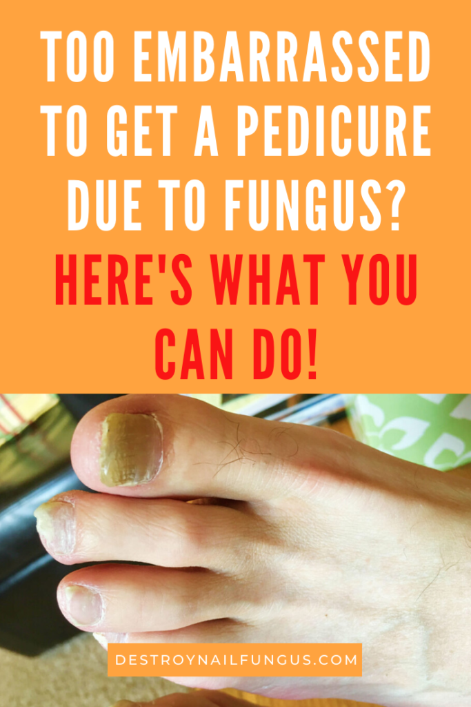 embarrassed to get a pedicure fungus