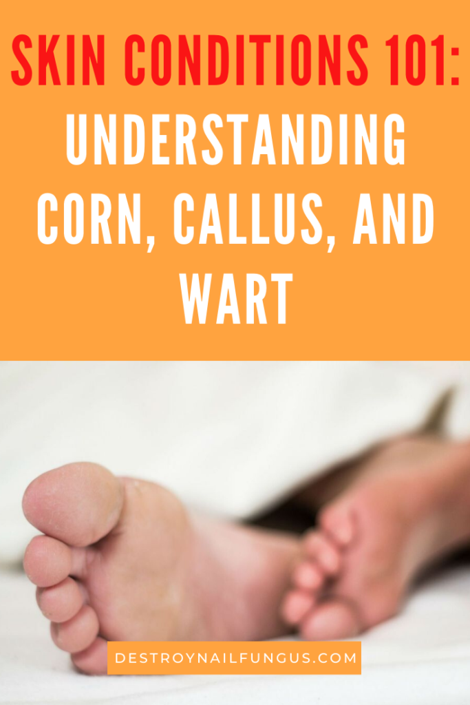 skin condition Corn versus callus versus wart
