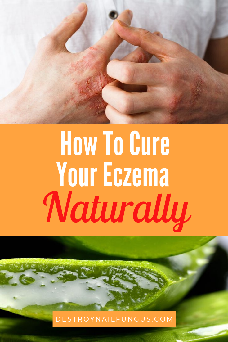 how to treat eczema with aloe vera