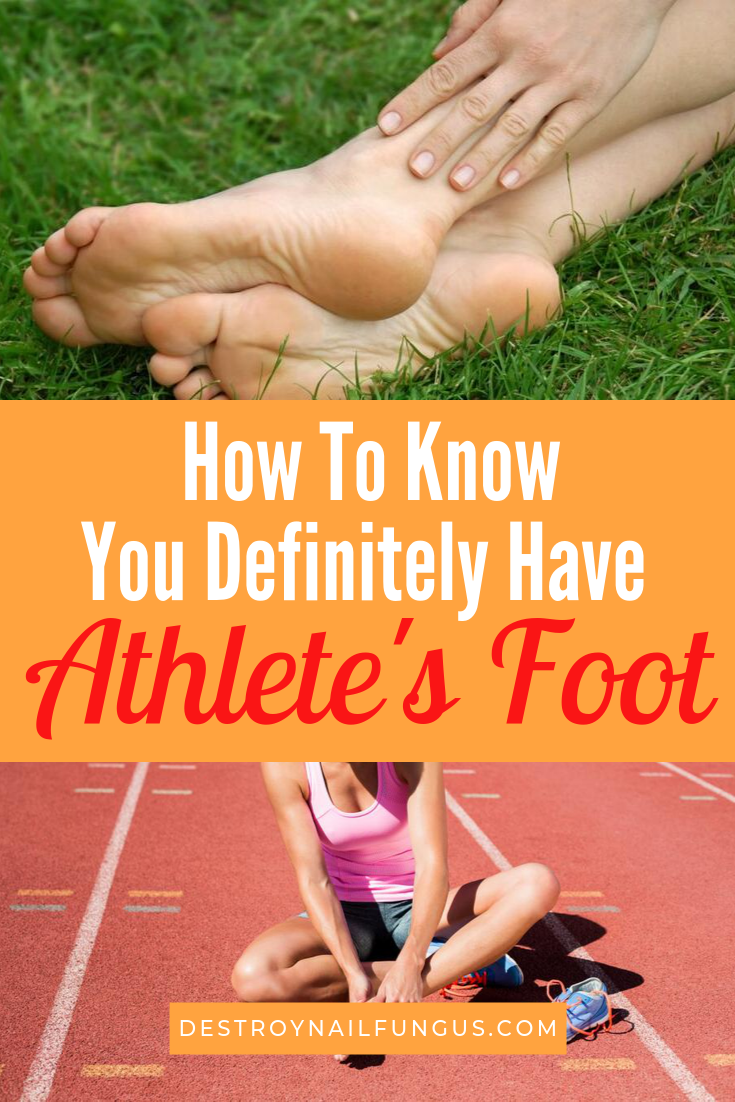 signs you have athlete's foot