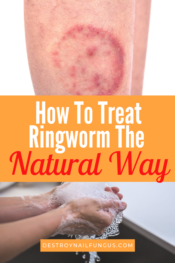 how to treat ringworm the natural way
