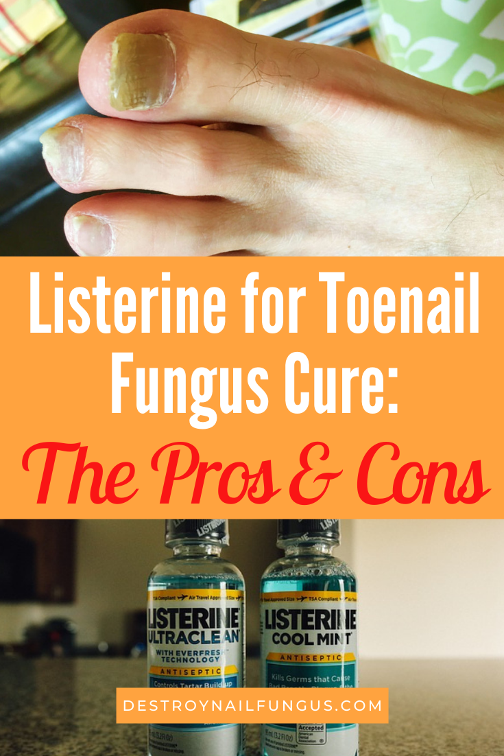 listerine toenail fungus cure pros and cons