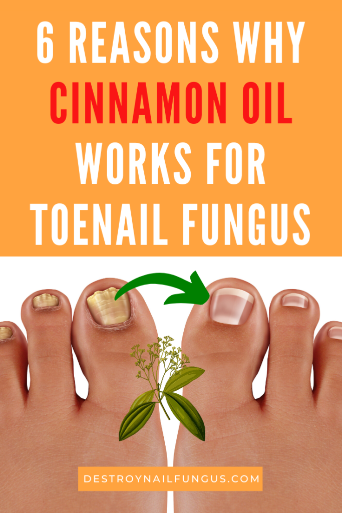 cinnamon oil for toenail fungus