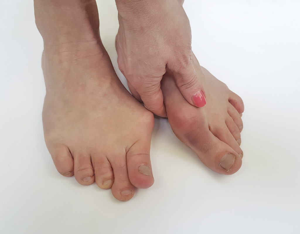 can bunions be reversed