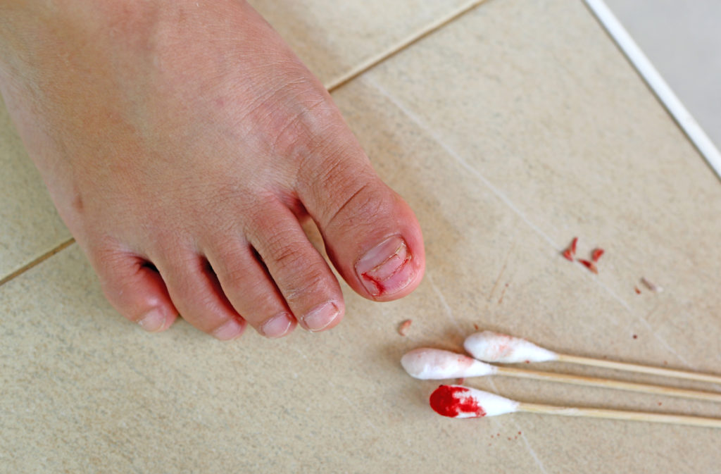 how to fix a dead toenail