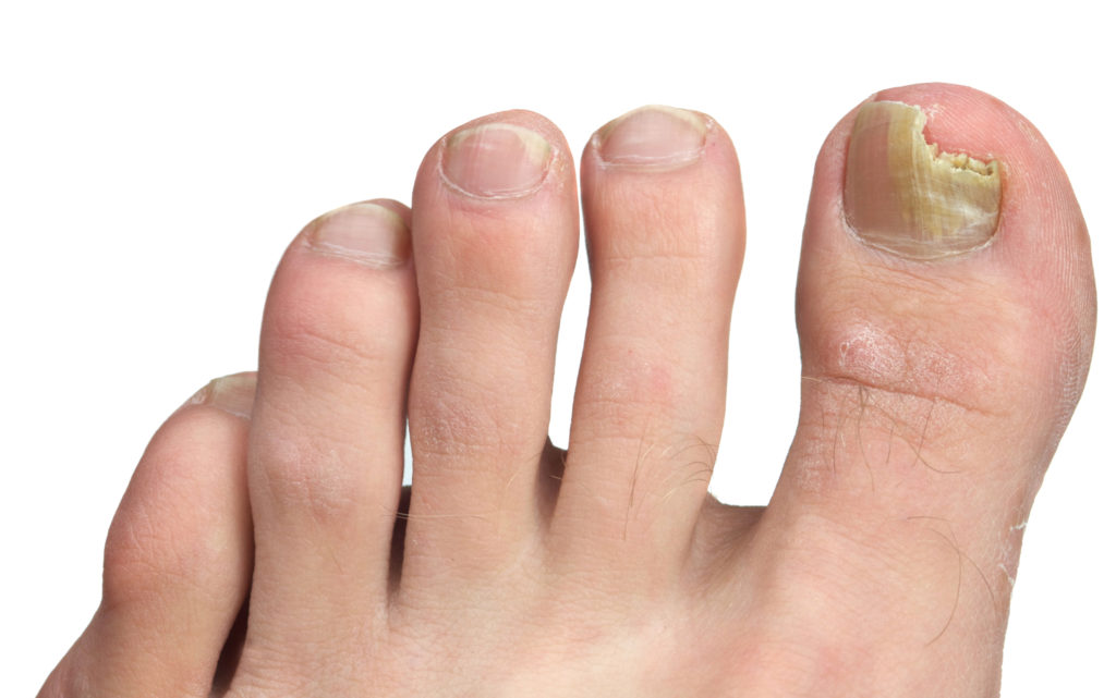 how to get rid of thick toenails fast