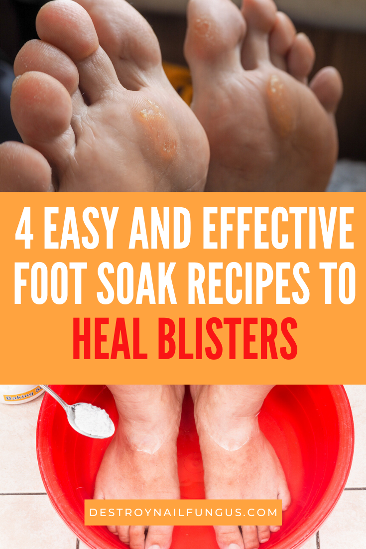 foot soak for blisters