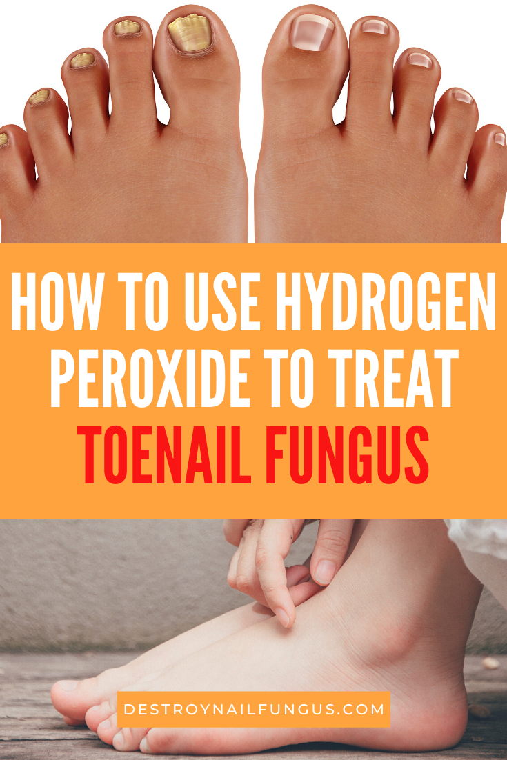 hydrogen peroxide and toenail fungus