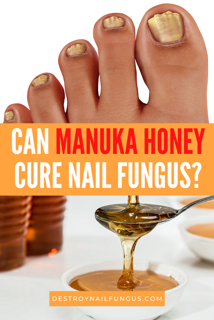 manuka honey for nail fungus