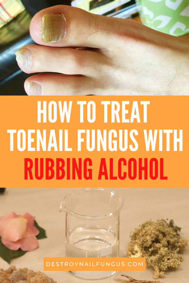 rubbing alcohol toenail fungus