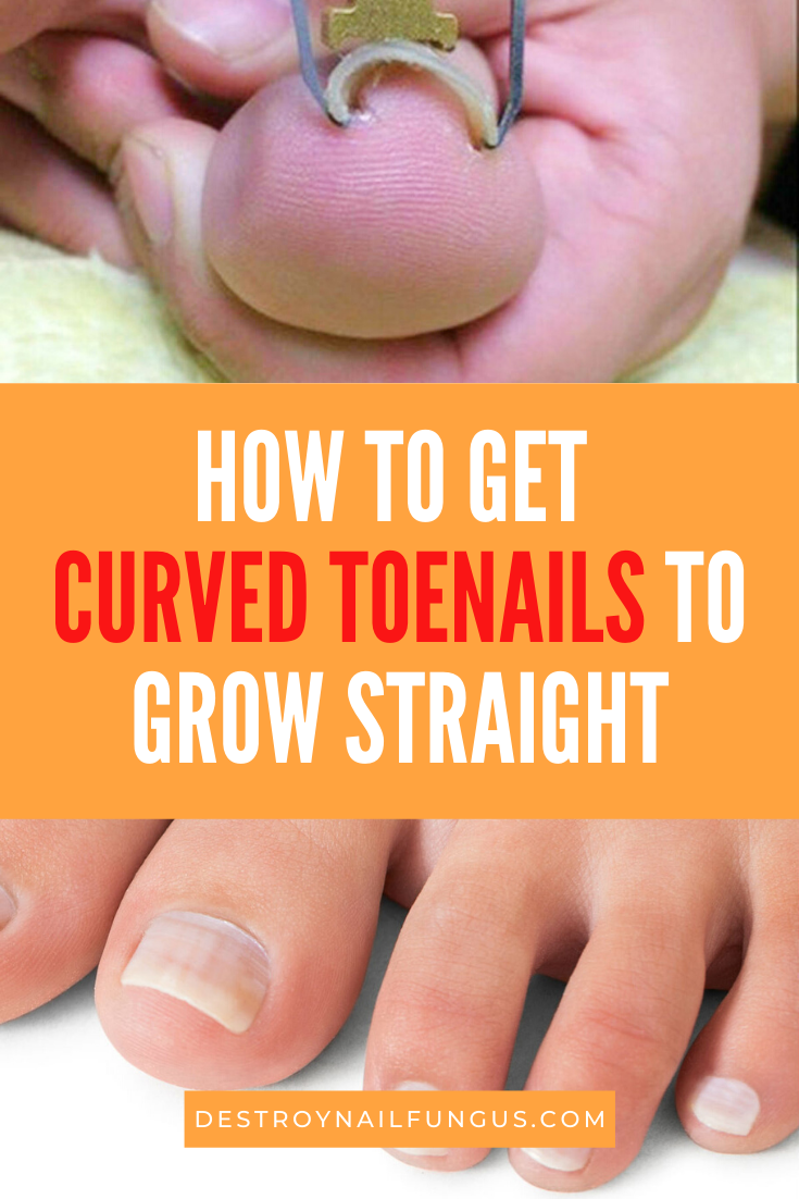 how to get toenails to grow straight