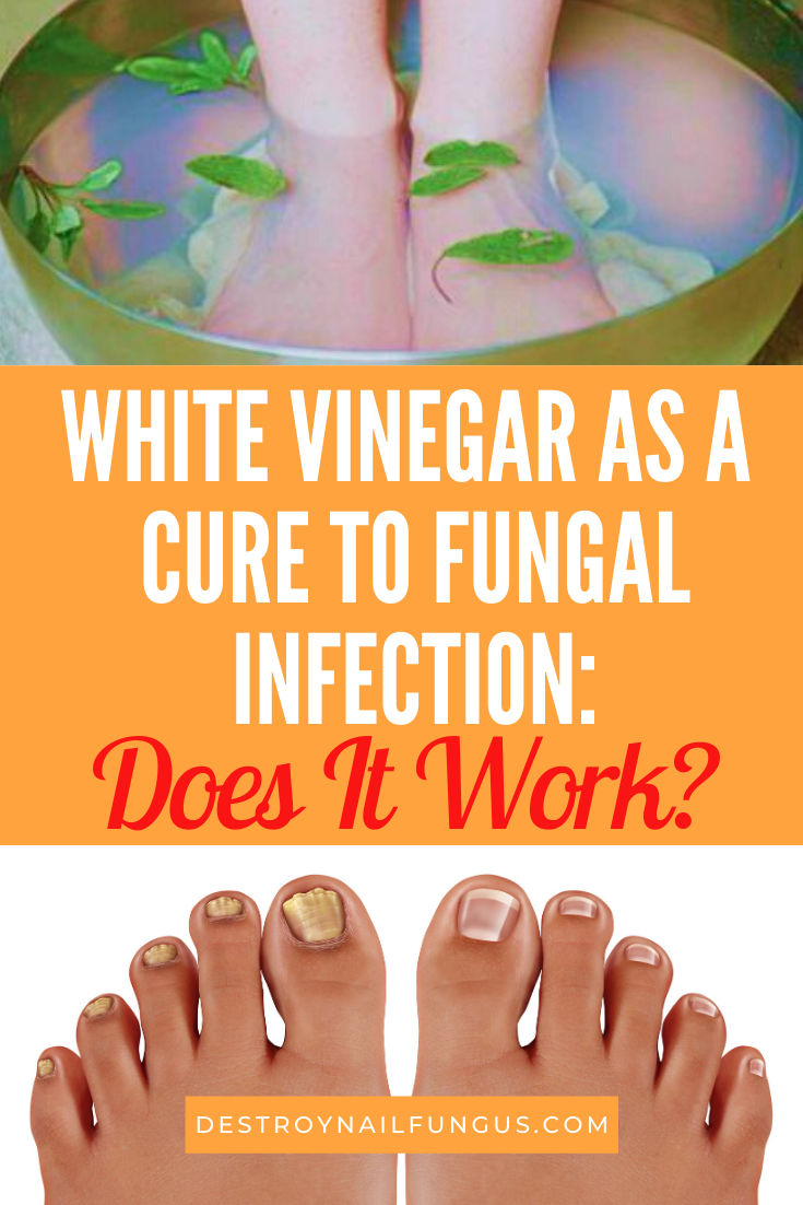 is white vinegar antifungal