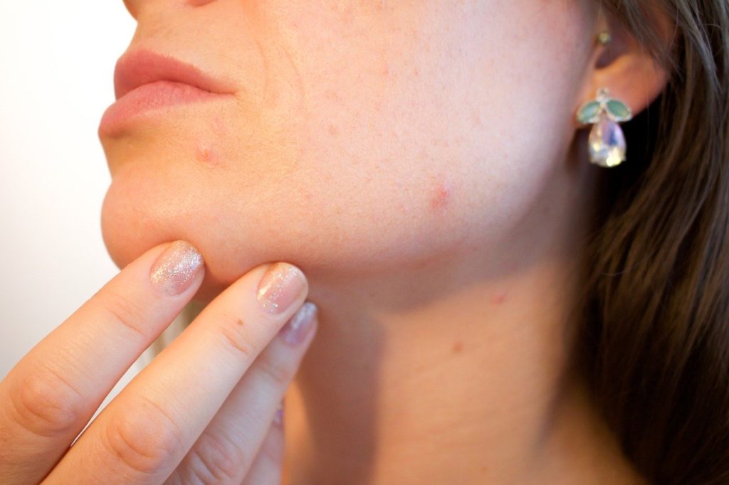 how to get rid of blemishes on your face