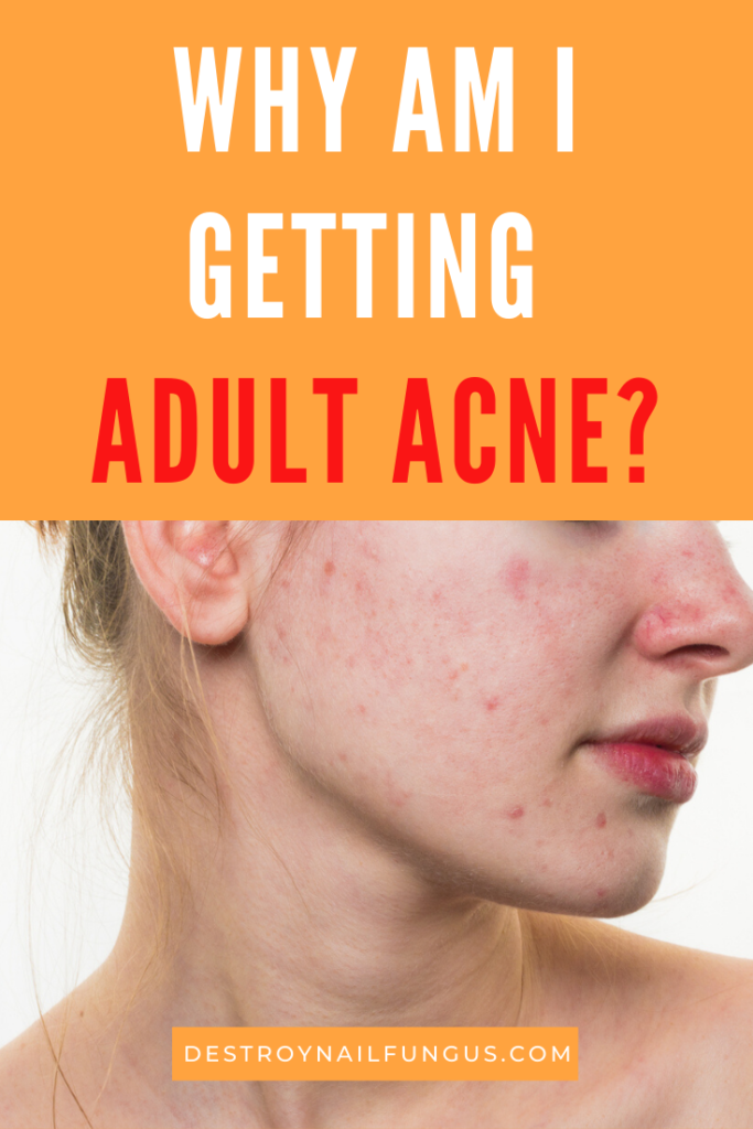 why do i have adult acne