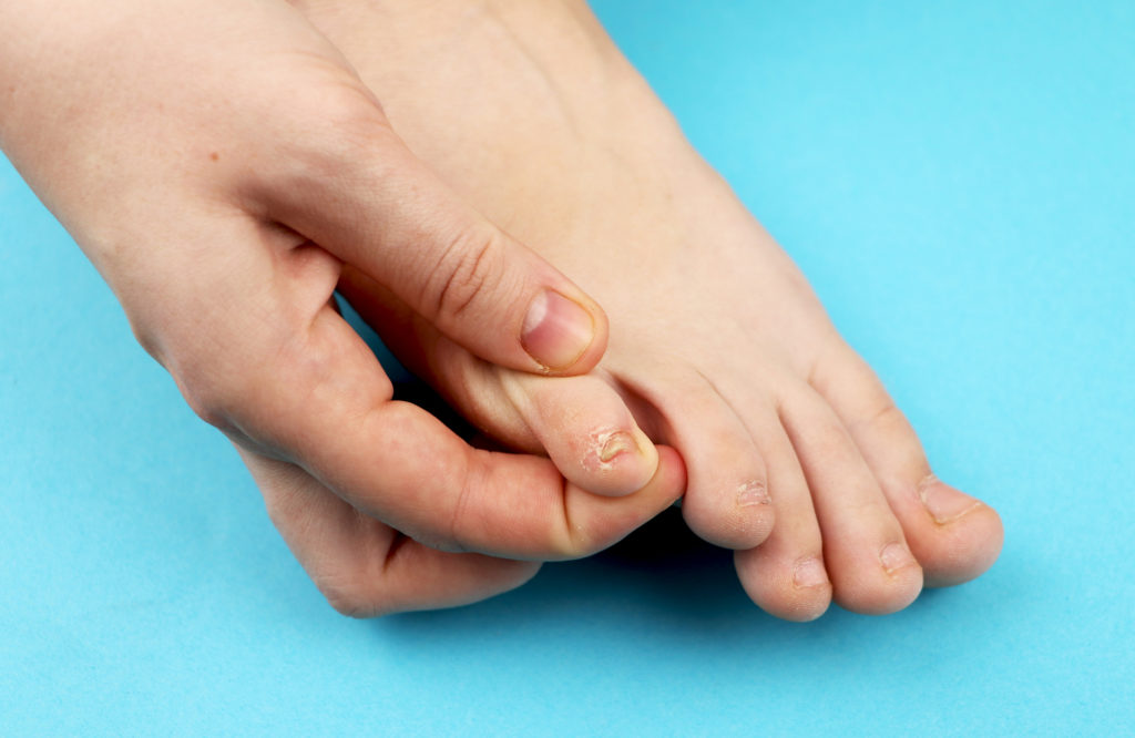 small pinky toenail