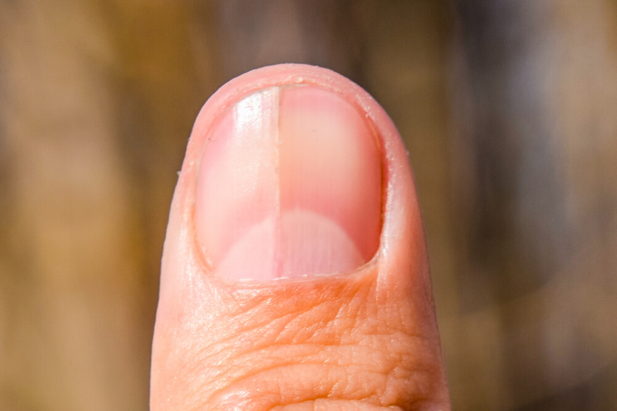 what do vertical ridges on nails mean