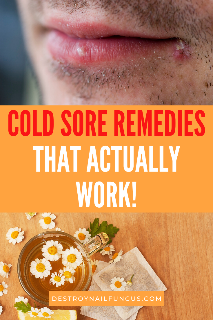 does toothpaste get rid of cold sores
