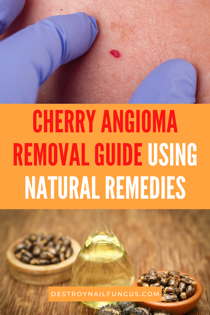 cherry angioma removal apple cider vinegar