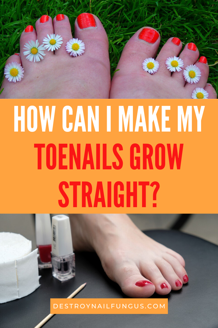 toenails growing at an angle