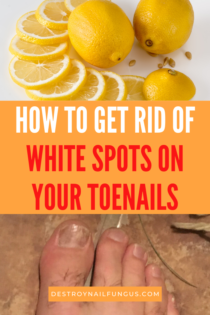 home remedies white spots on toenails