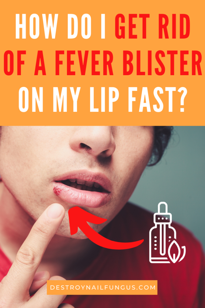fever blister remedy essential oils