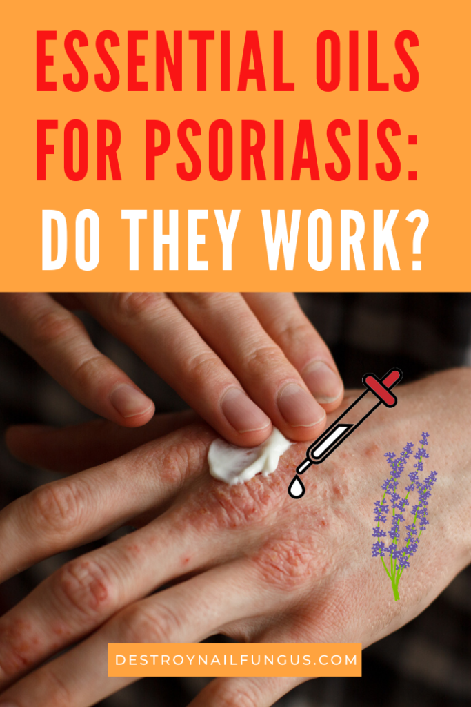 psoriasis remedies essential oils
