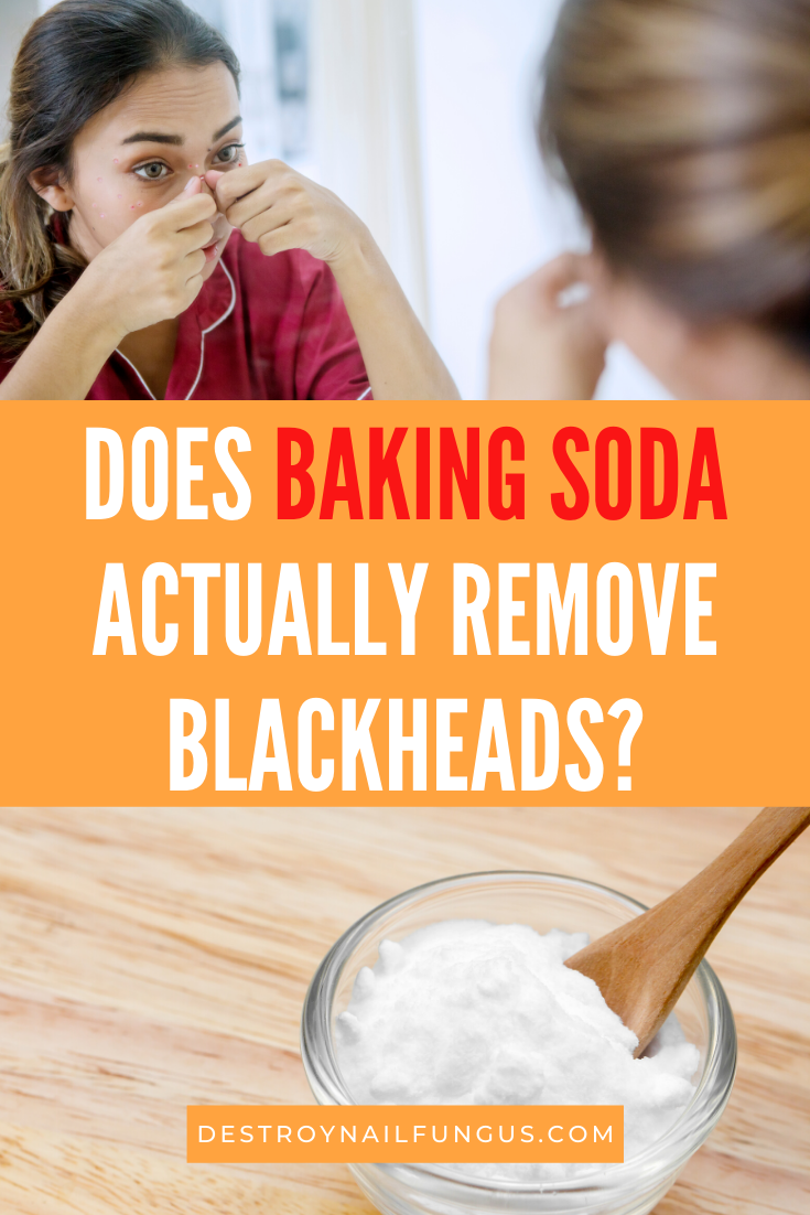 baking soda for blackheads