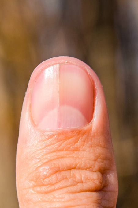 fingernail health signs