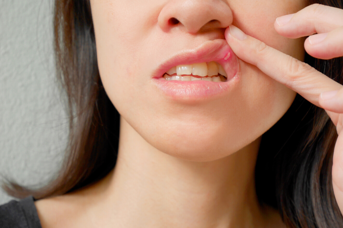 what causes canker sores in mouth