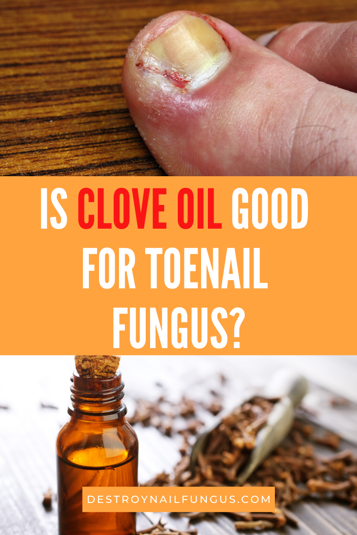 clove oil for toenail fungus