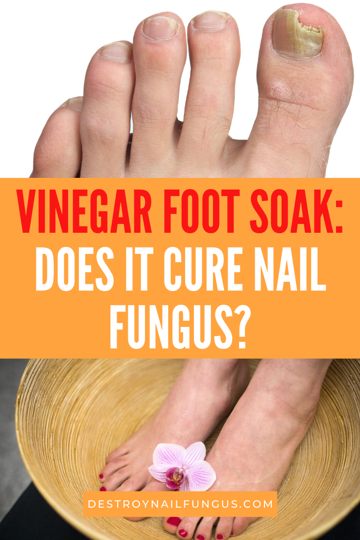 does vinegar kill fungus