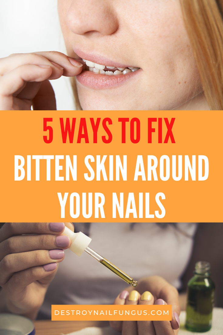 how to heal bitten skin around nails